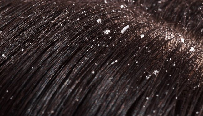 4 Kebiasaan Sepele yang Memicu Ketombe Berkelan 4 Kebiasaan Sepele yang Memicu Ketombe Berkelan