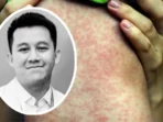 Dokter Muda Meninggal Karena Campak Dokter Muda Meninggal Karena Campak
